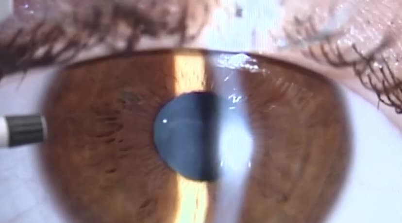 В России создали искусственную роговицу глаза