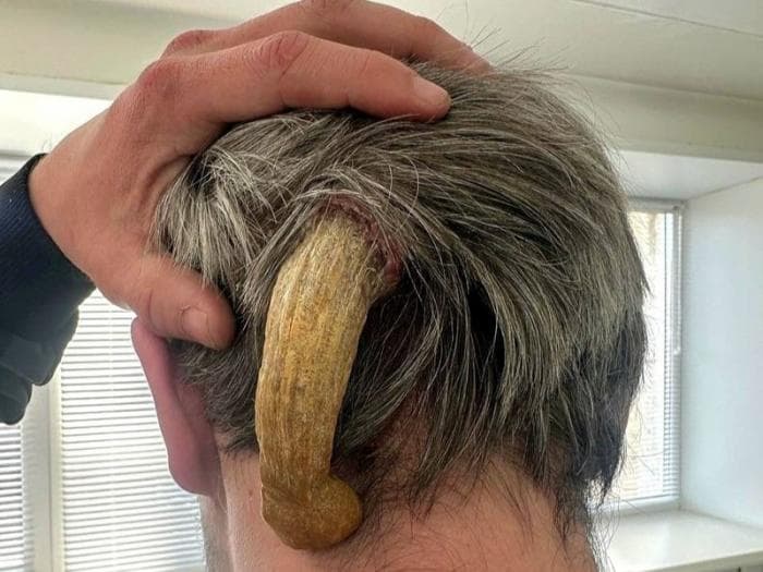 Врачи удалили у россиянина «дьявольский рог» длиной 11 см  