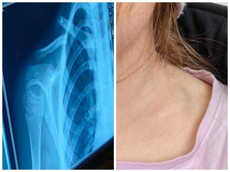 Школьница на свой день рождения сломала ключицу в игровой комнате Каменска-Уральского