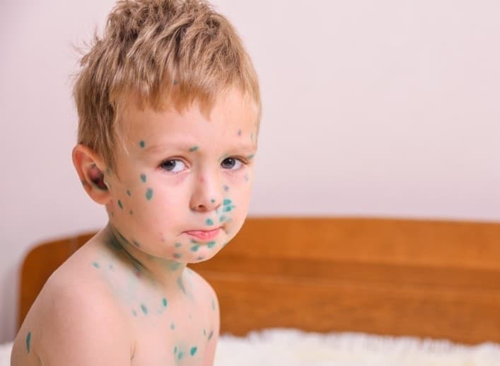 Ветрянка шагает по стране: почему дети массово заражаются, а вакцин не хватает